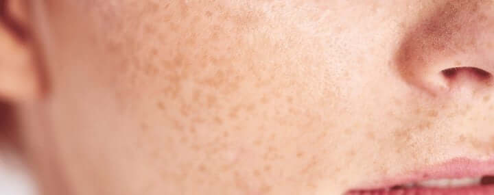 🌿 Peaux sensibles : les meilleures marques coréennes à adopter – peau sensible avec rougeurs et texture